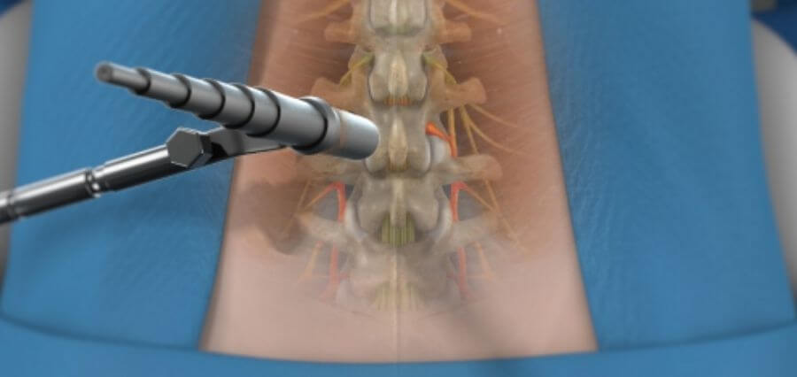 You are currently viewing Minimally Invasive Spine Surgery Is Not a Woo-Woo – The Dangers of Not Opting in for One